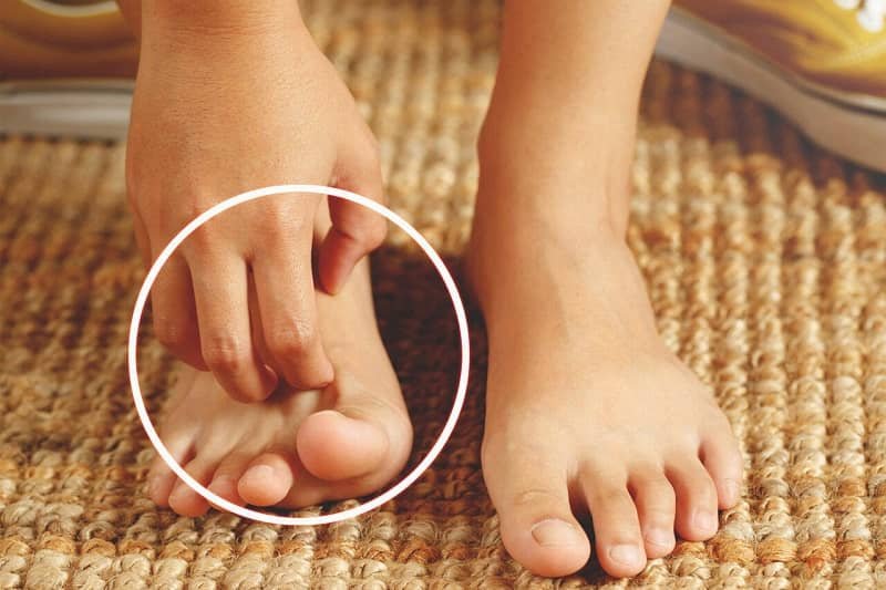 How to Treat Nail Fungus